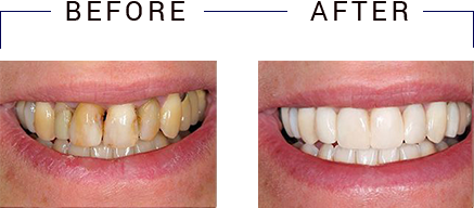 Dental Implants Dentist in Torrance